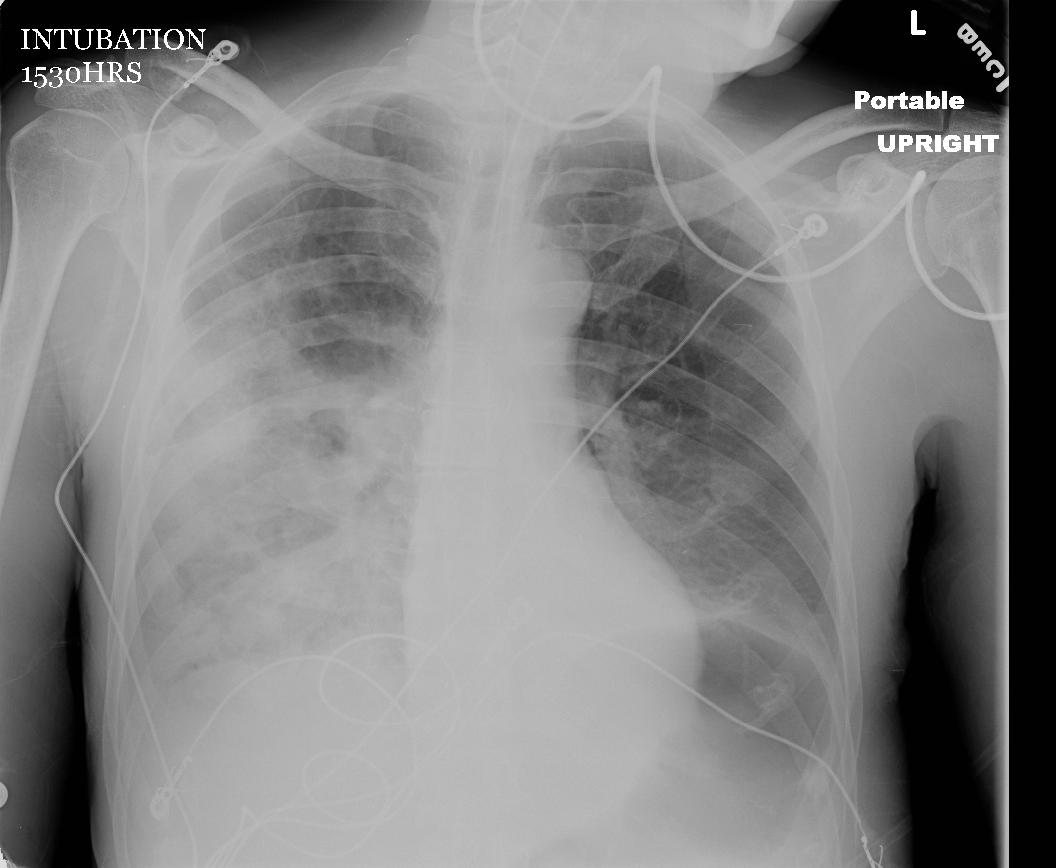 walking pneumonia chest x ray findings