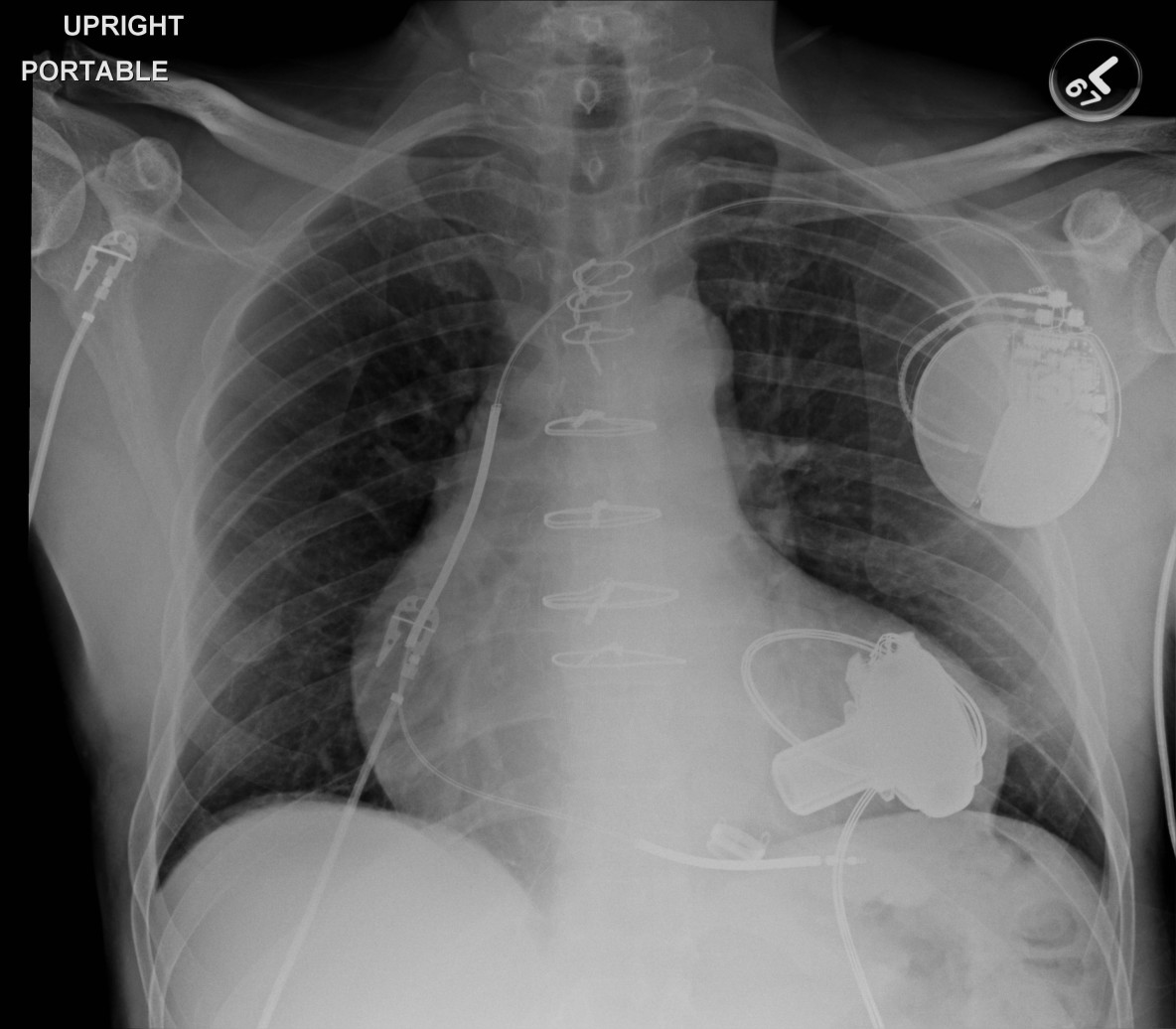 introduction-to-ventricular-assist-devices-university-of-maryland