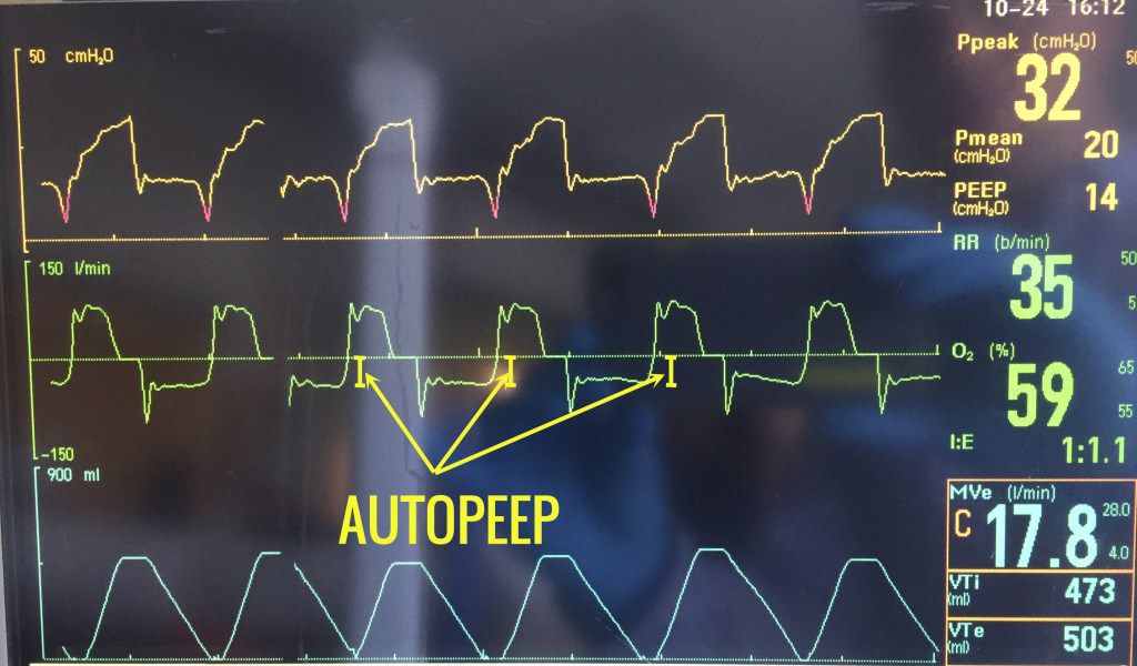 auto-peep-critical-care-practitioner