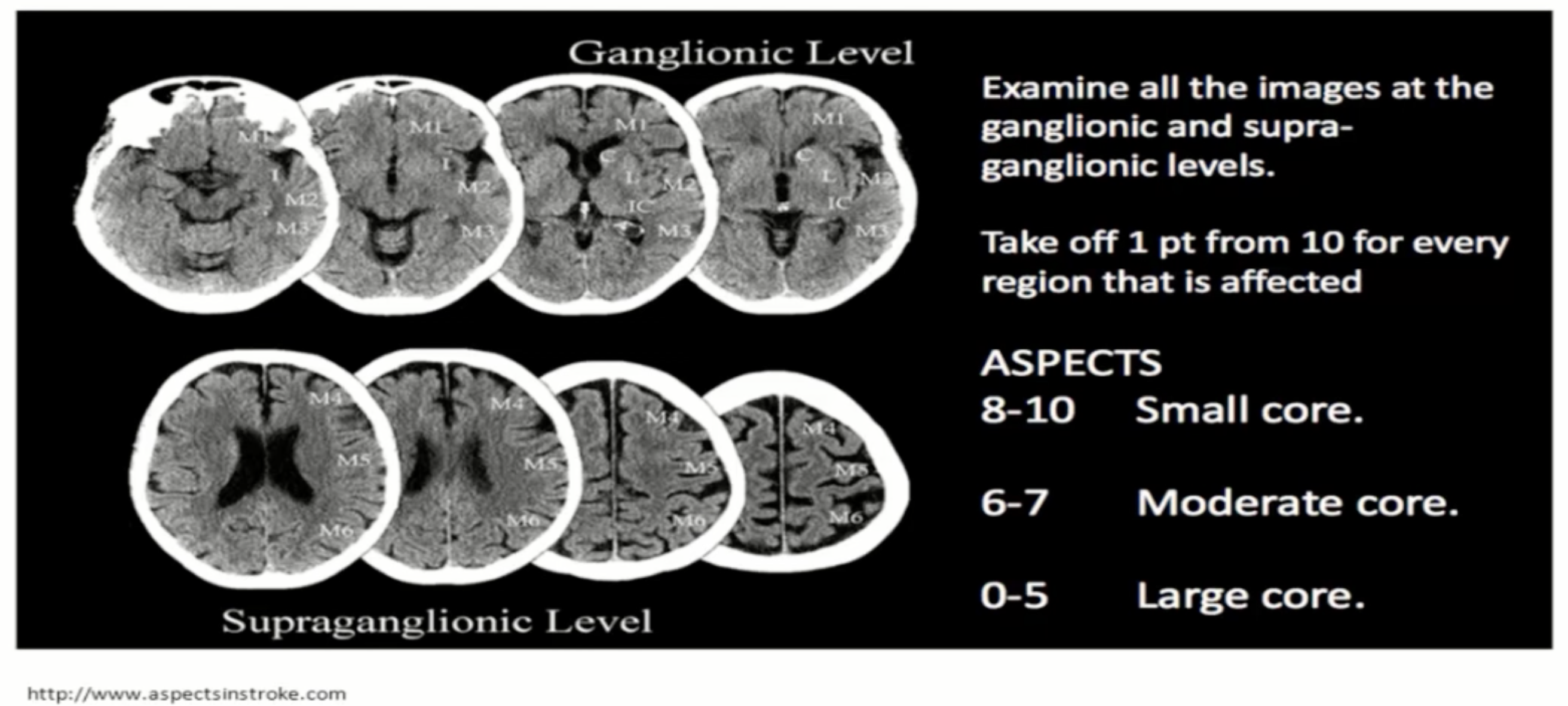 figure-2-from-aspects-alberta-stroke-program-early-ct-score