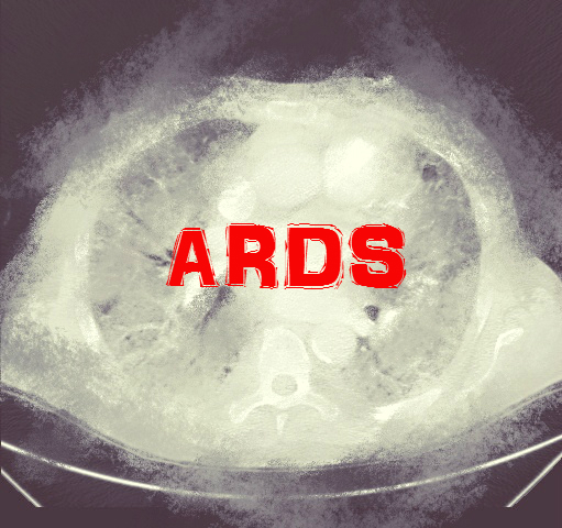 Ventilation Strategies During ECMO in patients with ARDS