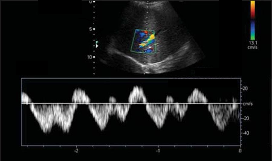 Spiegel – Starling Guyton and Venous Ultrasound