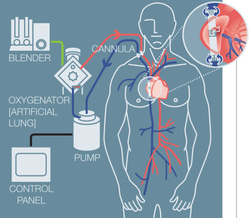 Osborn – ECMO and the Brain