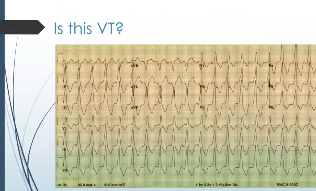 Zakaria – Ventricular Arrhythmias in the ICU