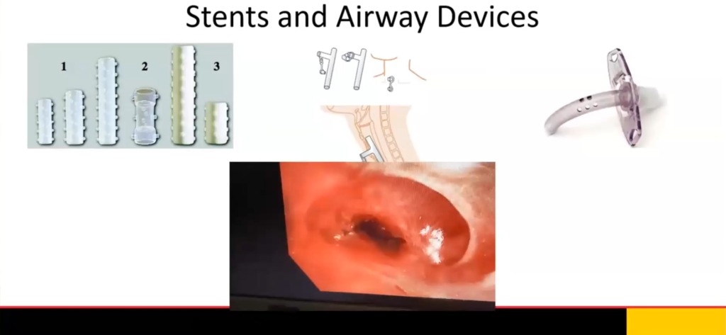 Pickering/Holden – Management of Massive Hemoptysis and Tracheal Complications in the ICU